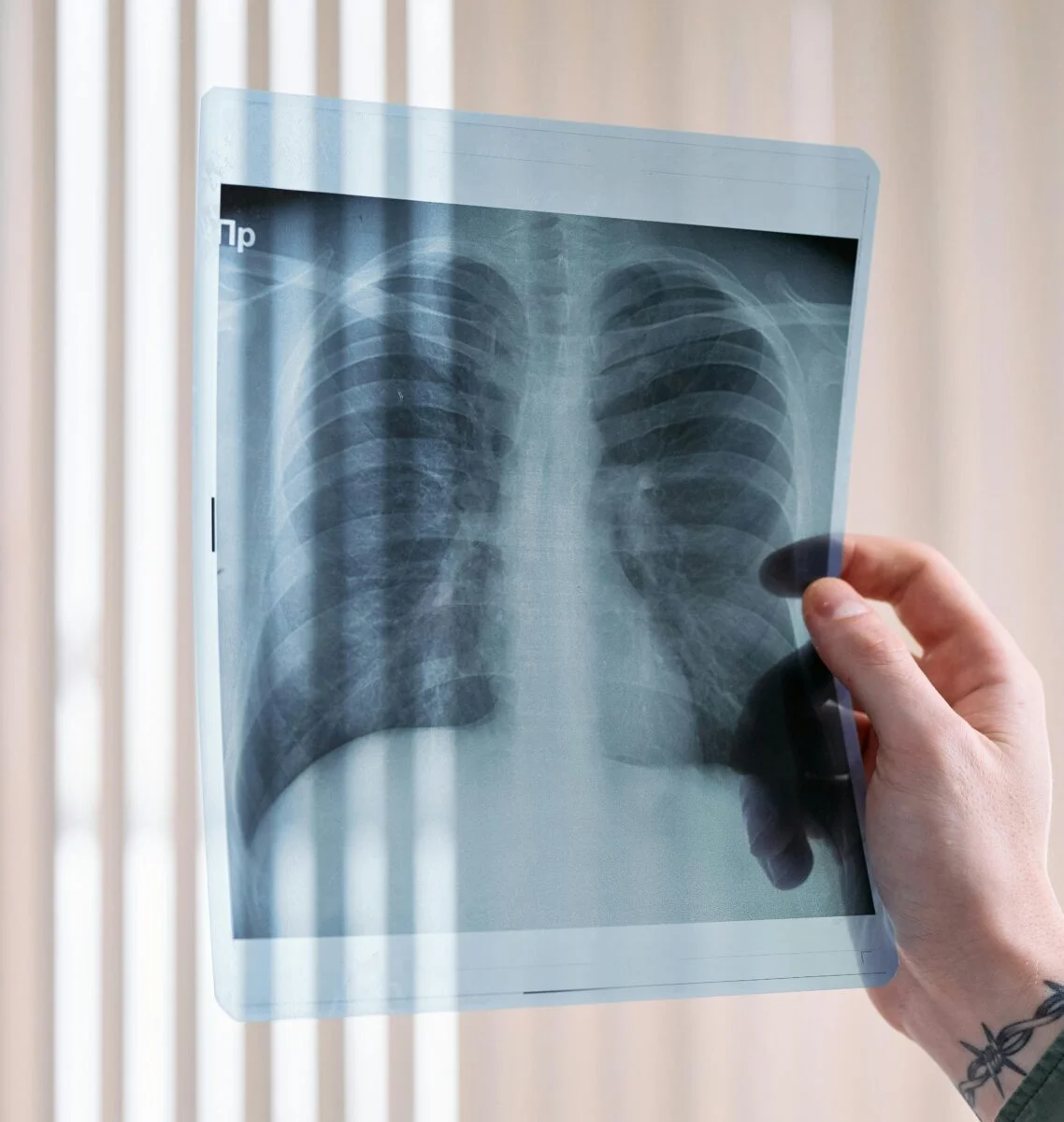 X-rays of a patient’s ribs are held up to the light.